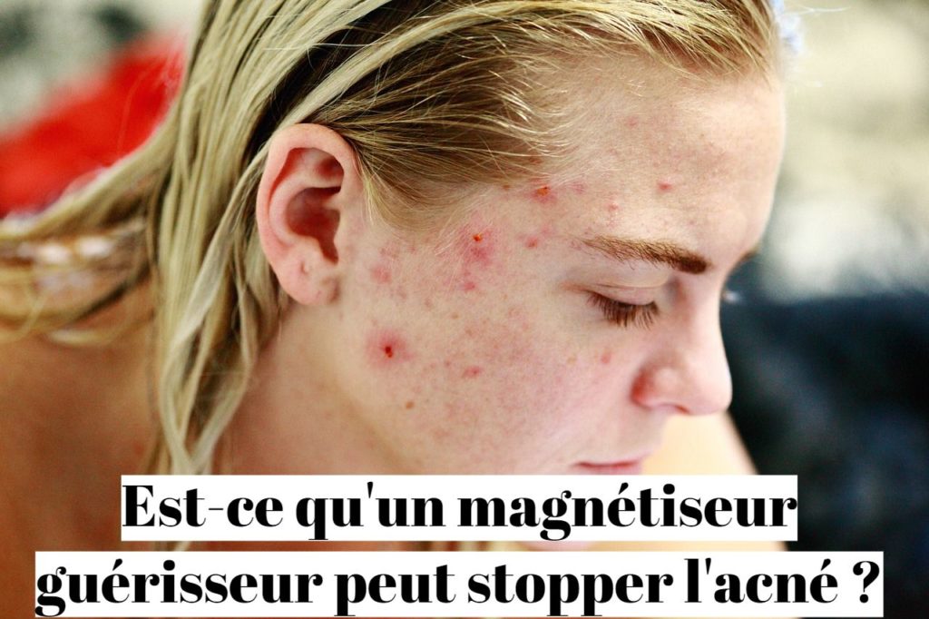 Est-ce qu'un magnétiseur guérisseur peut stopper l'acné ?